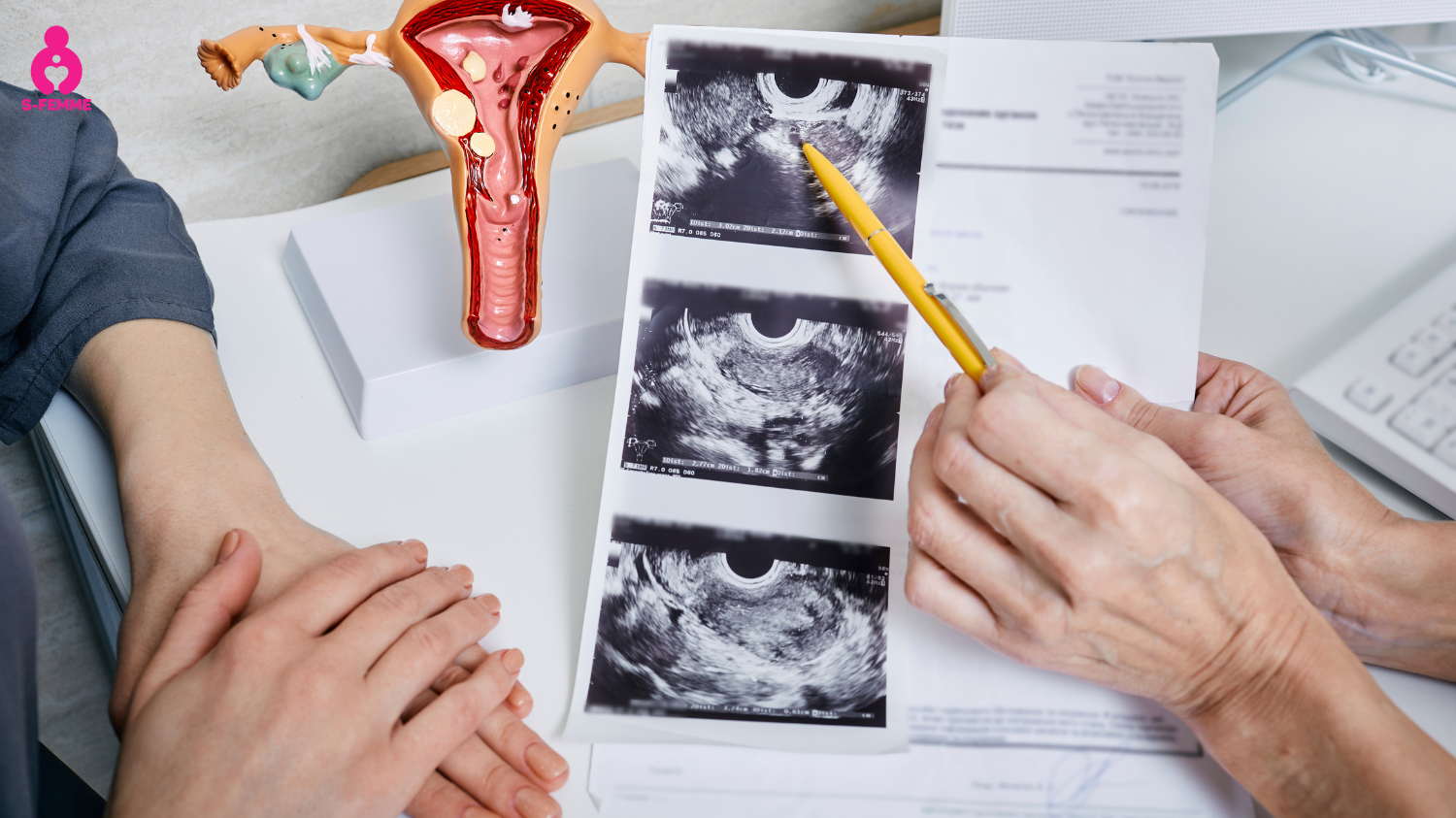 Quá kích buồng trứng là gì